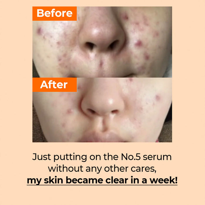 NUMBUZIN No.5 Goodbye Blemish Serum Nudie Glow Australia
